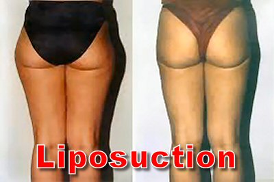 thigh liposuction before and after