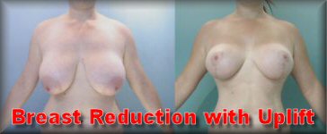 Breast reduction with uplift